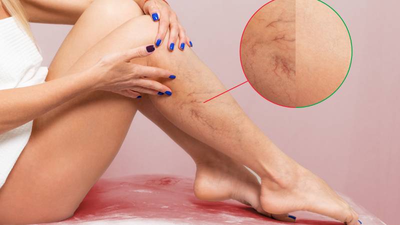 7 Things Your Doctor Hasn’t Told You About Spider Veins