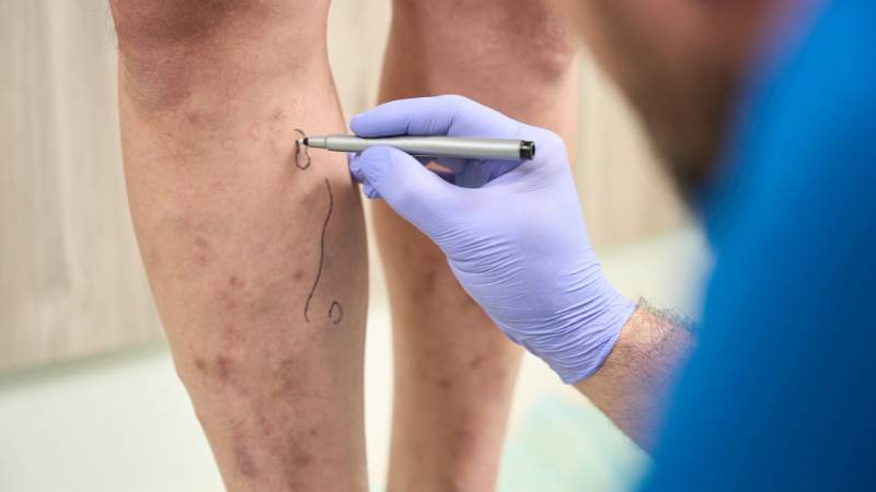 9 Things Your Doctor Hasn’t Told You About Varicose Veins