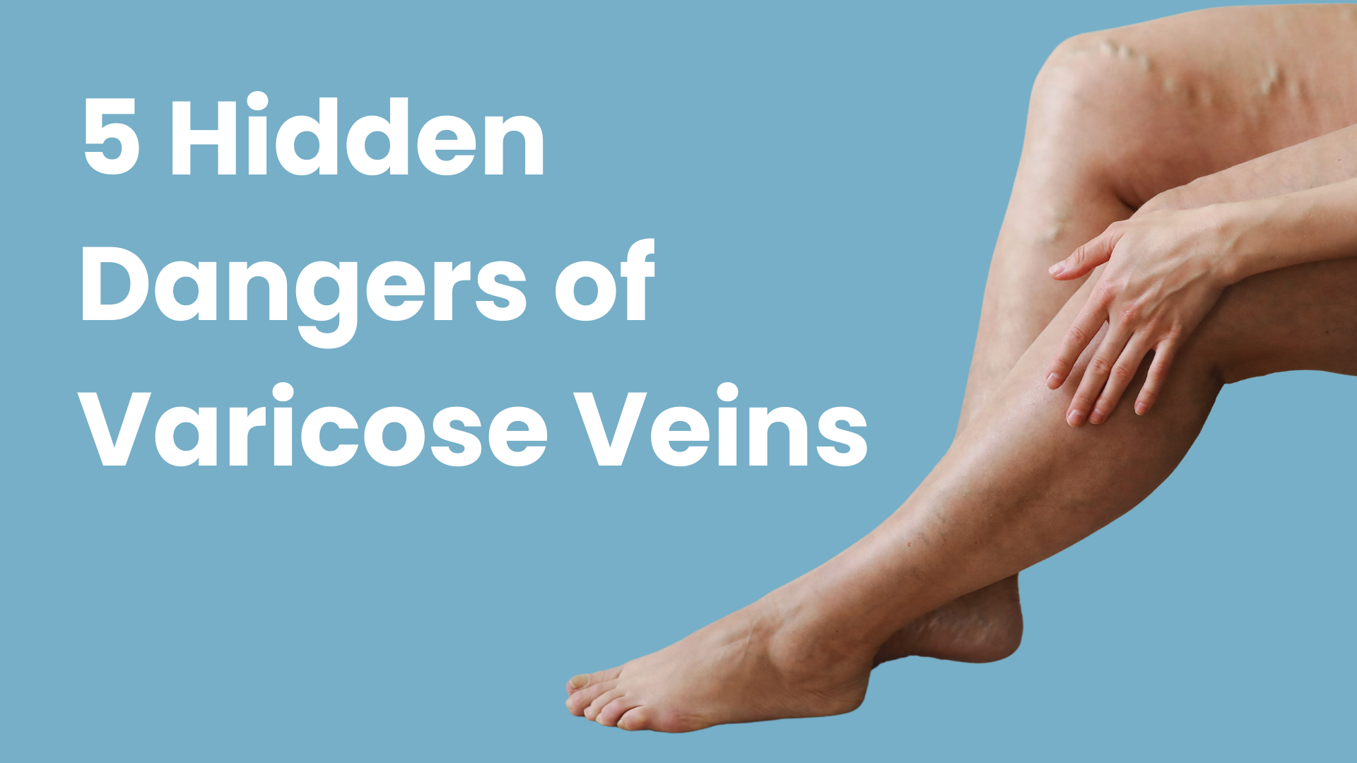 5 Hidden Dangers of Varicose Veins