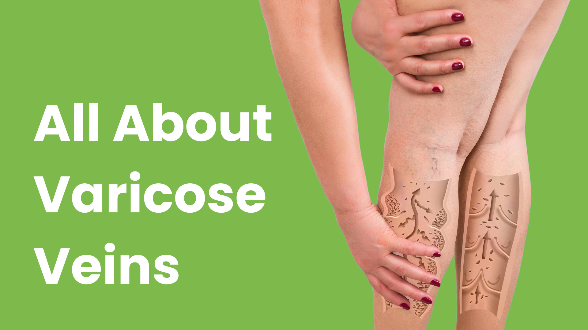 All About Varicose Veins