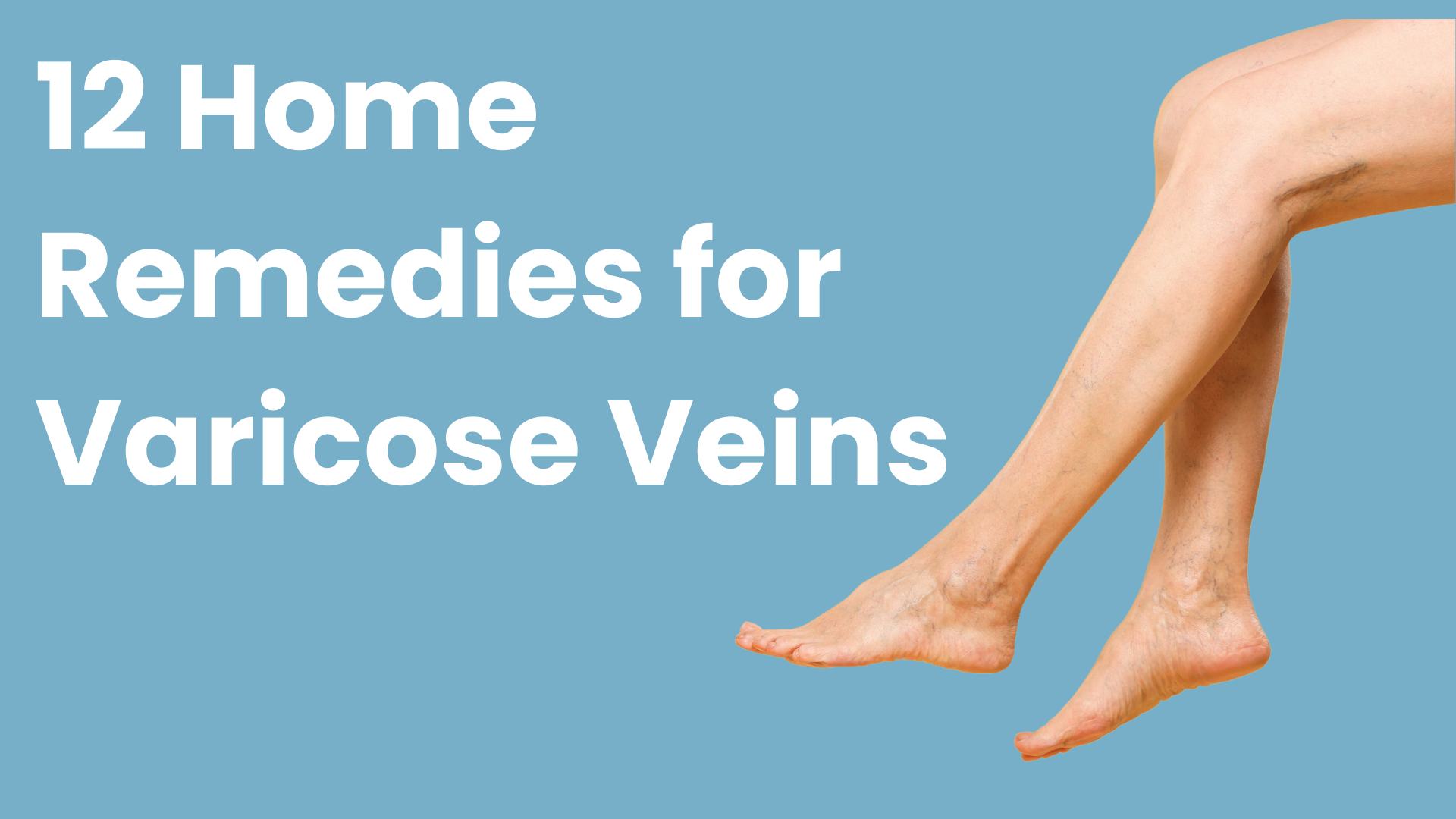 12 Home Remedies for Varicose Veins