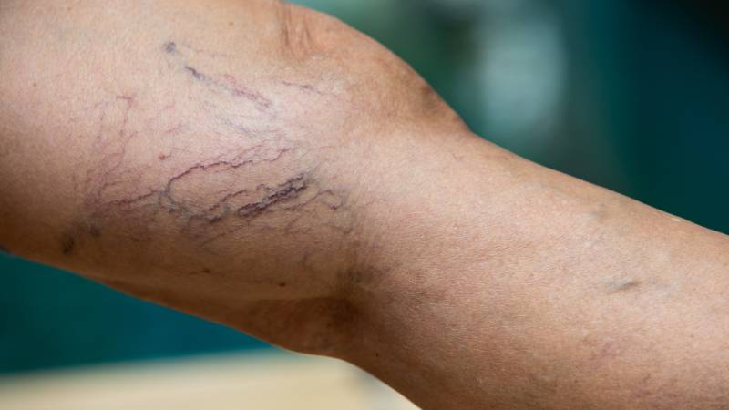 What Is The Treatment For Varicose Veins