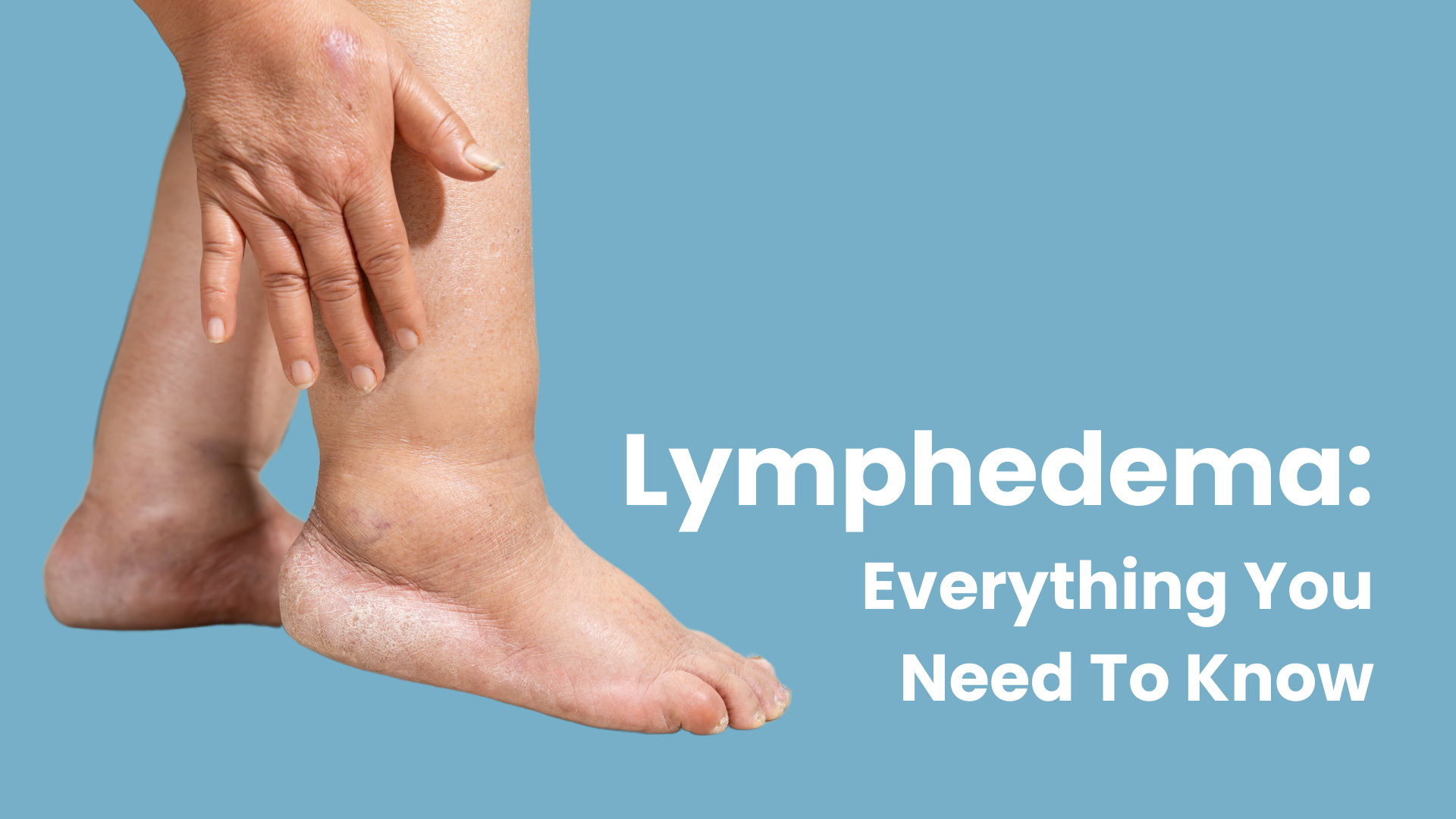 Lymphedema: Everything You Need To Know