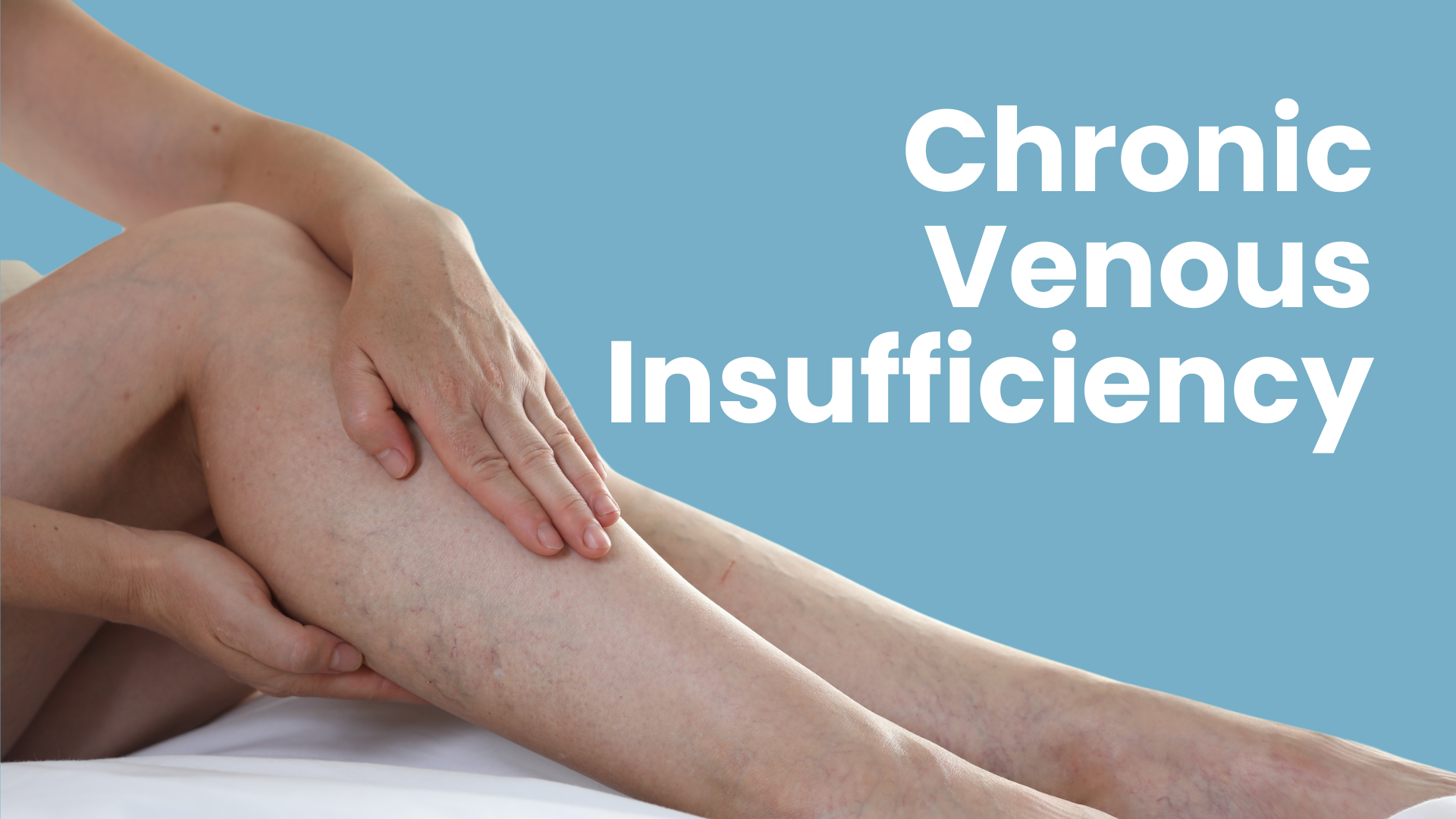 Chronic Venous Insufficiency